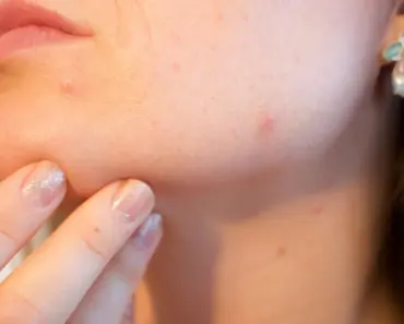 Why Arent My Acne Scars Fading