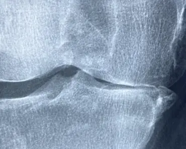 About Psoriatic Arthritis