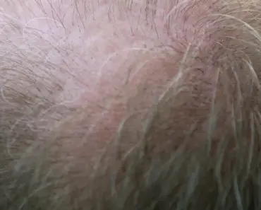 Why is My Hair so Thin I Can See My Scalp
