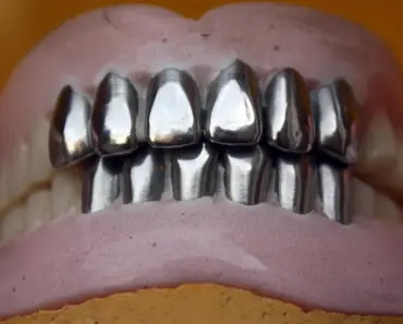 How Long Will it Take to Get Dental Implants