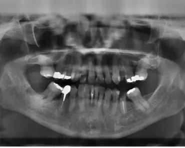 Are Dental Fillings Good as Teeth