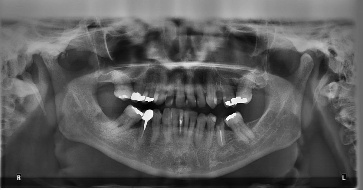 Are Dental Fillings Good as Teeth dental fillings good