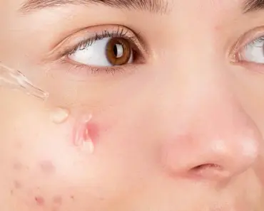How Can I Get Rid of Pores on My Nose