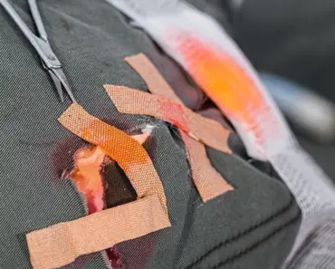 When Should I Be Worried About a Burn