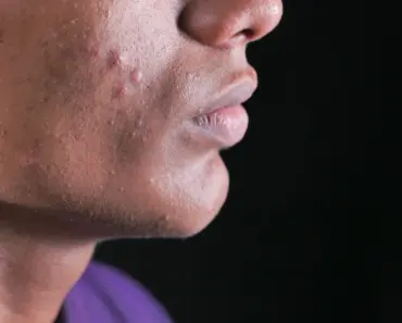 How Long Does it Take for a Sebaceous Cyst to Go Away on Its Own