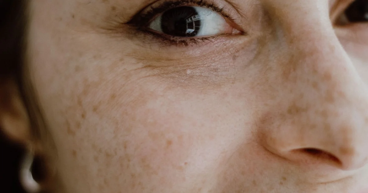 Which Acid is Best for Large Pores clean facial skin pores