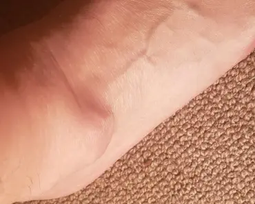 Do Sebaceous Cysts Have a Sac