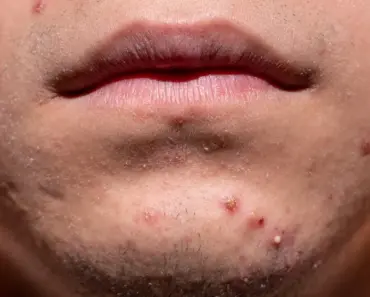 Will Salt Draw Out Blackheads