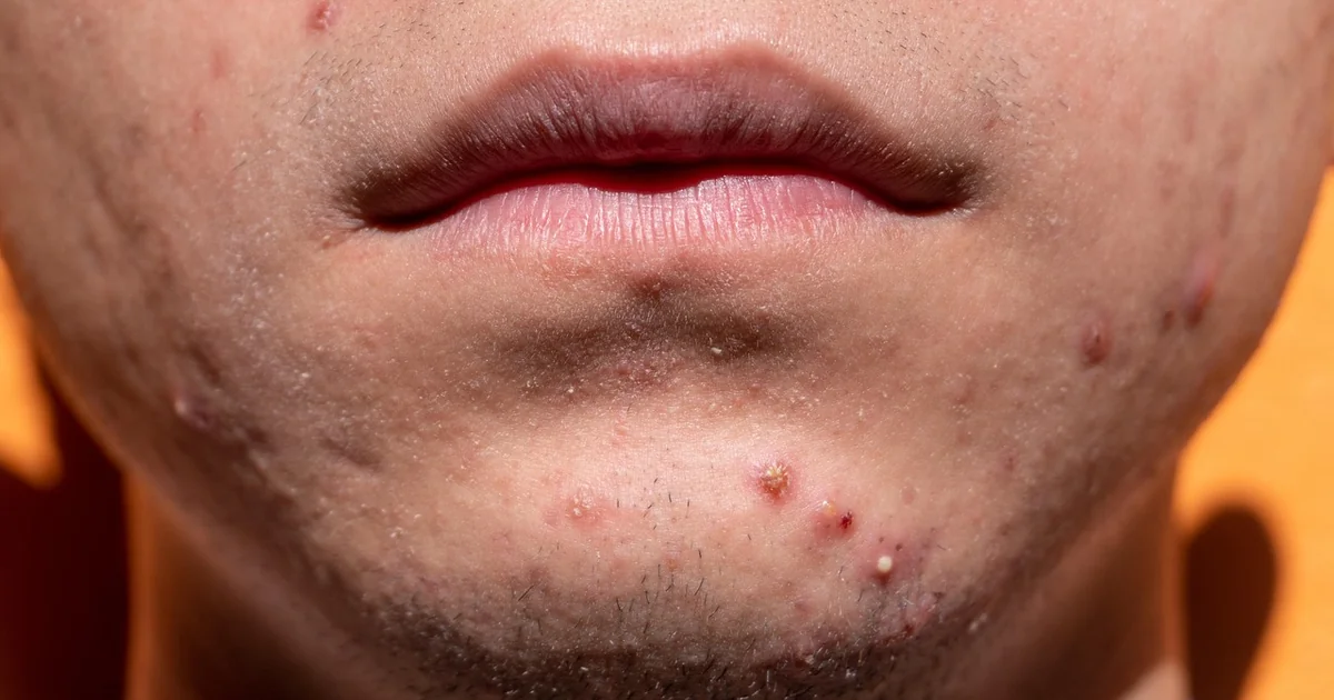 Will Salt Draw Out Blackheads facial skincare treatment