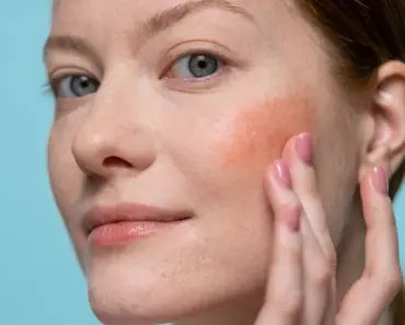 Why Are Some Blackheads Huge
